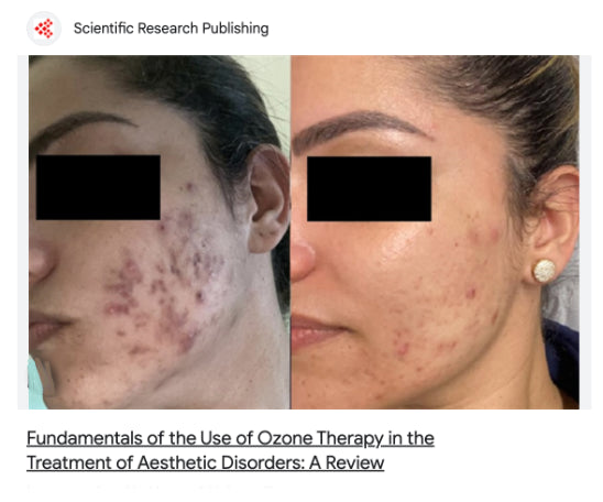A before-and-after split-screen comparison of a woman's face showing acne and facial redness improvement, with the eyes obscured by black blocks. Text at the top reads 'Scientific Research Publishing' and text at the bottom reads 'Fundamentals of the Use of Ozone Therapy in the Treatment of Aesthetic Disorders: A Review'.